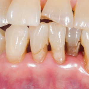 Periodontal diease treatment for the Hadlock-irondale area