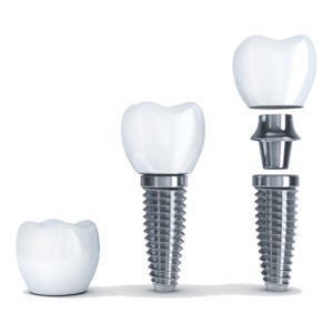 Dental Implants Display