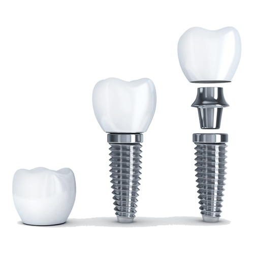 Dental Implants Display