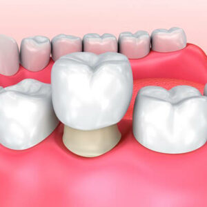 Dental-Crowns