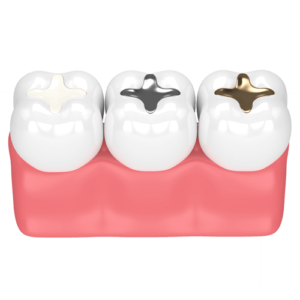 dental-implants fillings