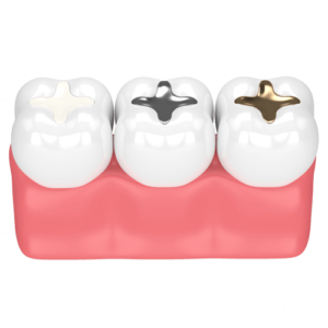 Fillings - Dental Fillings